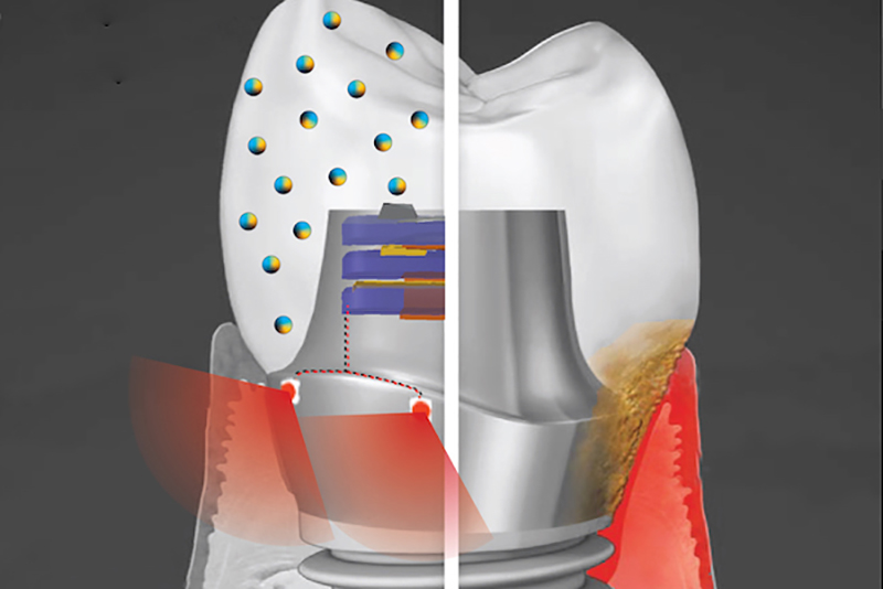 The smart dental implant