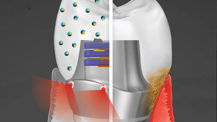 smart-dental-implant-web.jpg