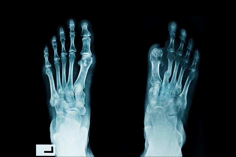 Stock image of an x-ray of two feet, one with an amputated big toe
