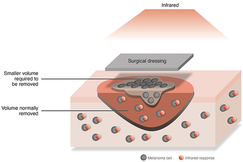 A graphic of how the infrared activates the surgical dressing around melanoma cells